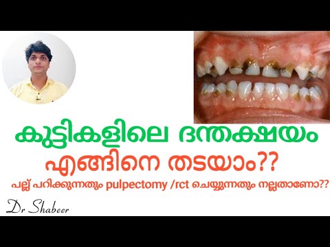 കുട്ടികളിലെ ദന്തക്ഷയം|ശ്രദ്ധിക്കേണ്ടത്‍|pulpectomy/rct ചെയ്യുന്നത് നല്ലതാണോ!? health tips malayalam.