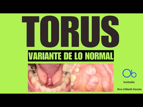 Variante de lo normal: TORUS