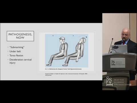 An Overview of Pediatric Hangman's Fracture - Michael Montalbano, M.D.