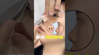 재수술 코성형 성형 시술