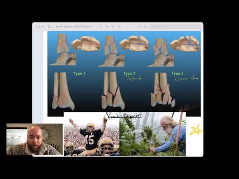 Reudi-Allgower Classification of Pilon Fractures