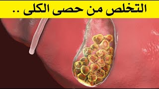 التخلص من حصى الكلى : تعرف على 7 وصفات منزلية للعلاج