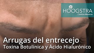 Arrugas del entrecejo - Toxina Botulínica y Ácido Hialurónico (21106)