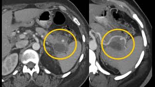 CT Evaluation of the Spleen: Challenges in Diagnosis Part 3