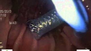 SEMS assisted retrieval of a migrated cystogastrostomy pigtail stent