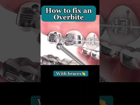 Overbite Correction #shorts