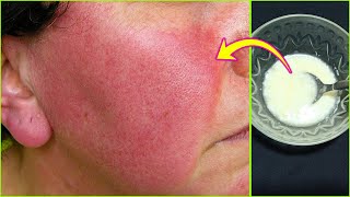 How to get rid of redness on face fast, best treatment for redness on face