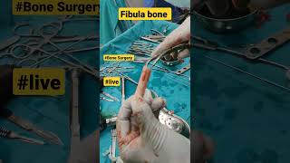 Fibula Bone Graft | #fibula #fibulafracture #bonegraft #bonegrafting #bonesurgery #bonefracture #acl