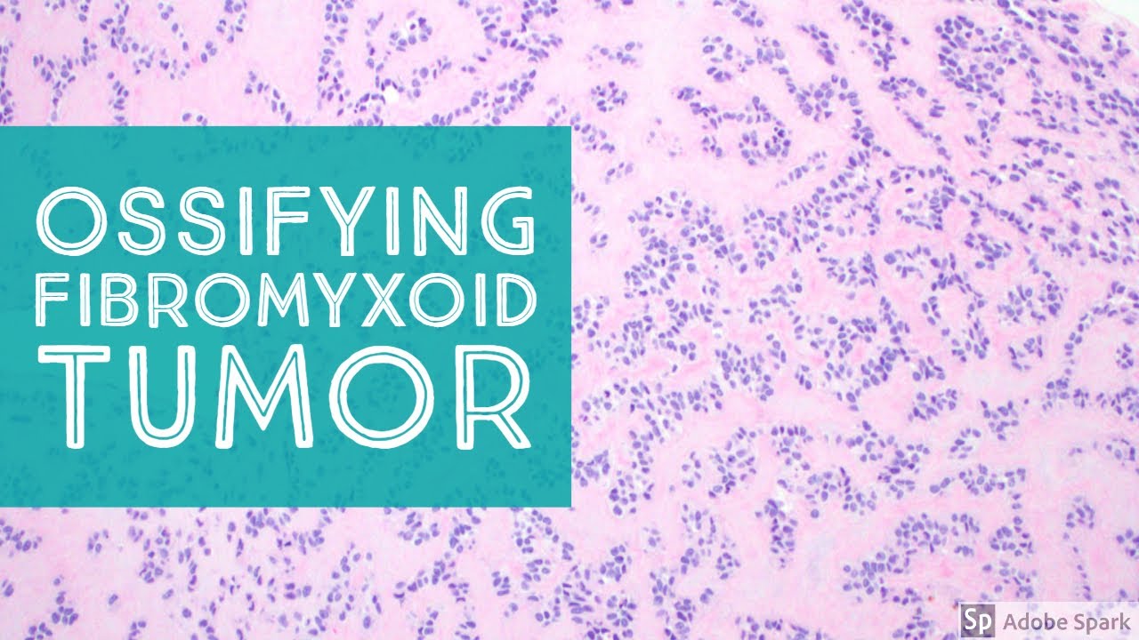 Ossifying Fibromyxoid Tumor (OFMT) of Soft Parts