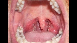 Sore Throat or Strep Throat?