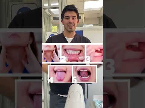 Prevención contra el Cáncer Oral