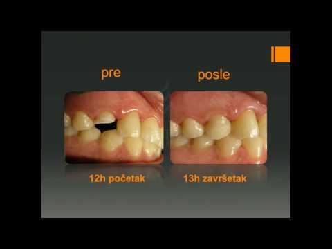 Od polomljenog zuba do krune za 1 sat