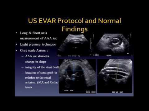 Complications of Endovascular Stent Graft Repair