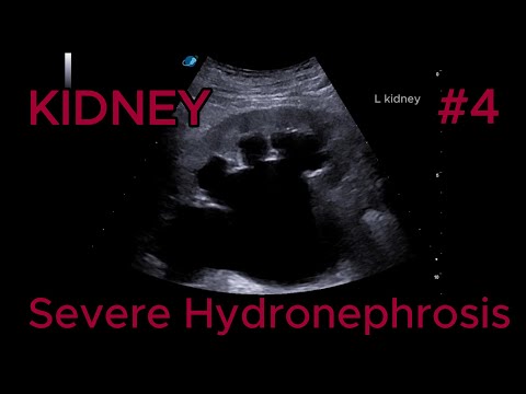 Severe bilateral hydronephrosis video preview