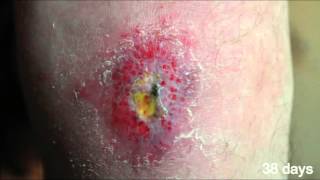 My Scraped Knee Heals