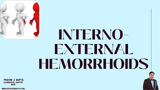 INTERNO-EXTERNAL HEMORRHOID SURGERY BY OUR TECHNIQUE