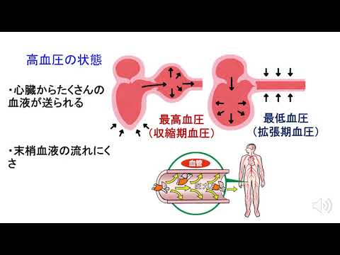 脳卒中と高血圧対策:塩代替品は数百万人の死亡を防ぐ可能性がある