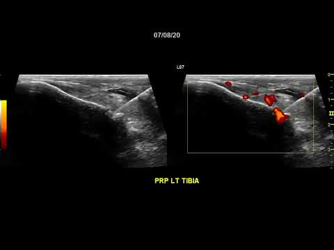 Intraosseous Injection of Knee Bone Marrow Lesion through a Cortical Break on Lateral Tibial Plateau