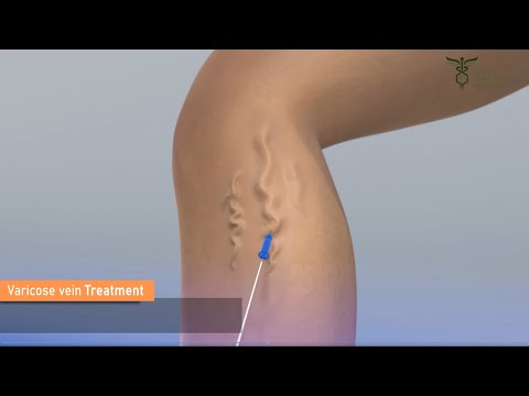 Varicose Vein Ablation