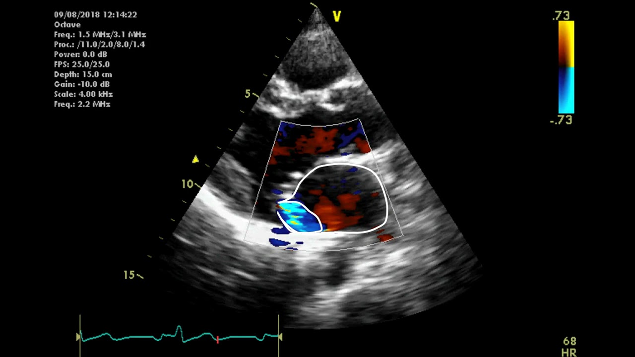 Echocardiographic assessment of the mitral valve