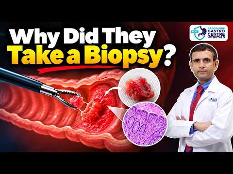 Biopsy Advised? Don't Panic! Myths vs Facts About Biopsy & Cancer!