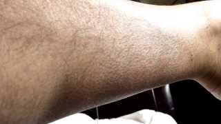 Calf fasciculations (Twitching) BFS - Benign Fasciculation Syndrome