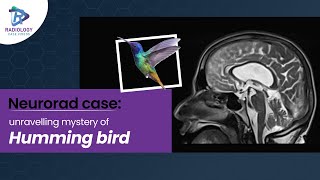 Neurorad case Unravelling mystery of humming bird