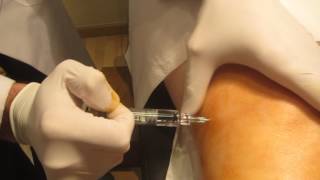 Infiltración rodilla con Acido Hialuronico.Lubricante de articulaciones