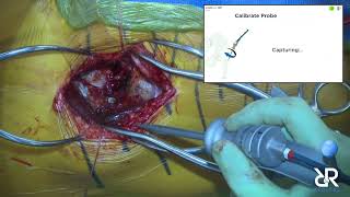 Dr. Stefan Kreuzer performs Total Hip Arthroplasty Using Intellijoint (No Audio)