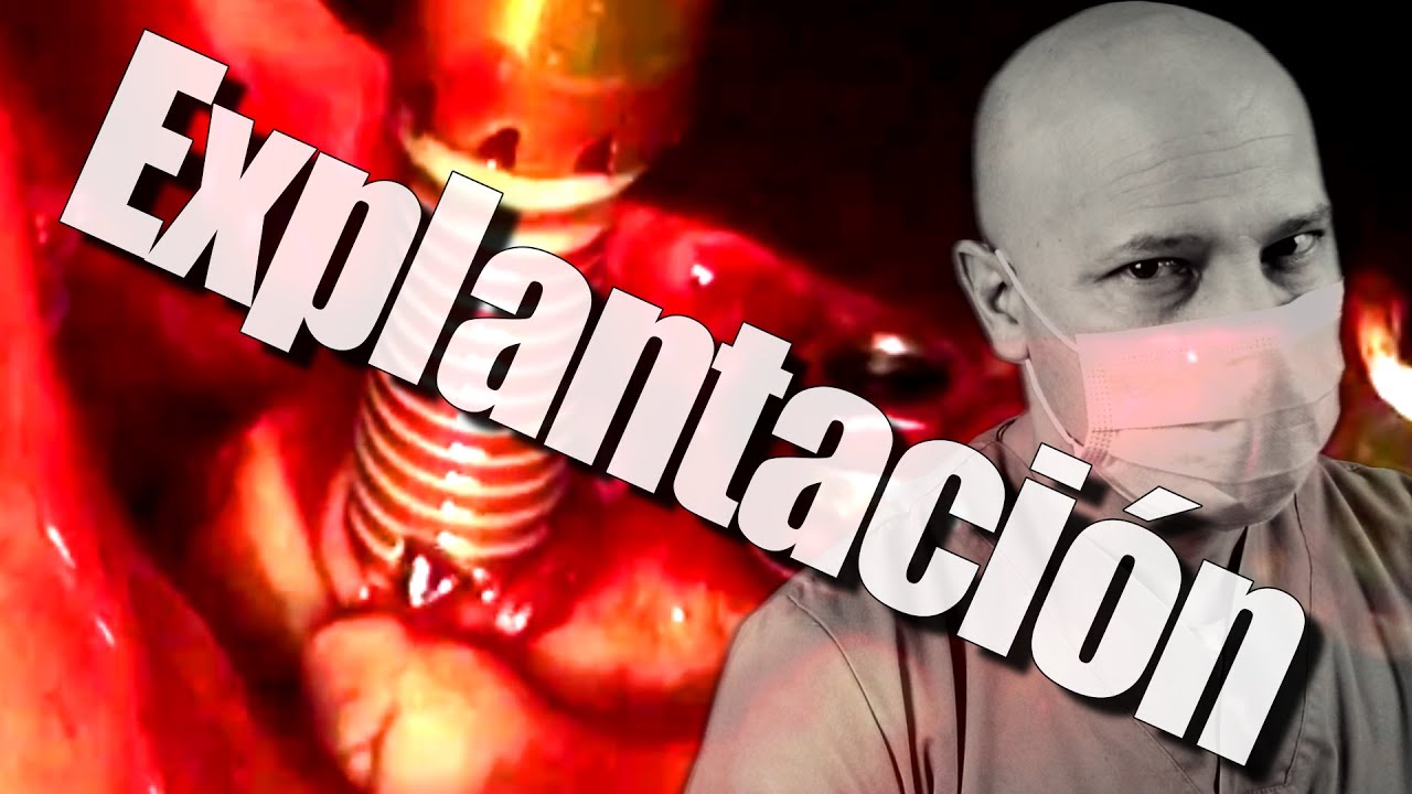 Watch Extracción de un IMPLANTE (como se saca un implante dental) todo lo que debes saber 👀 Now Extracción de un IMPLANTE (como se saca un implante dental) todo lo que debes saber 👀