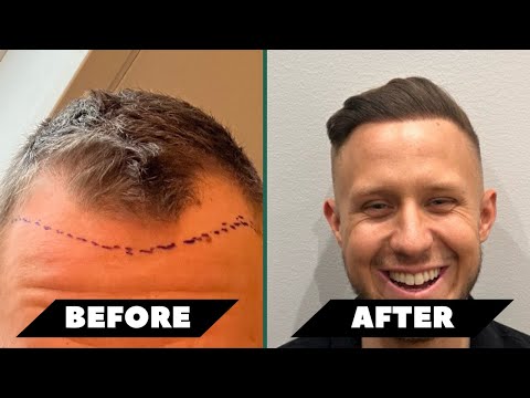 Alex (22) efter sin hårtransplantation (2000 hårsäckar)