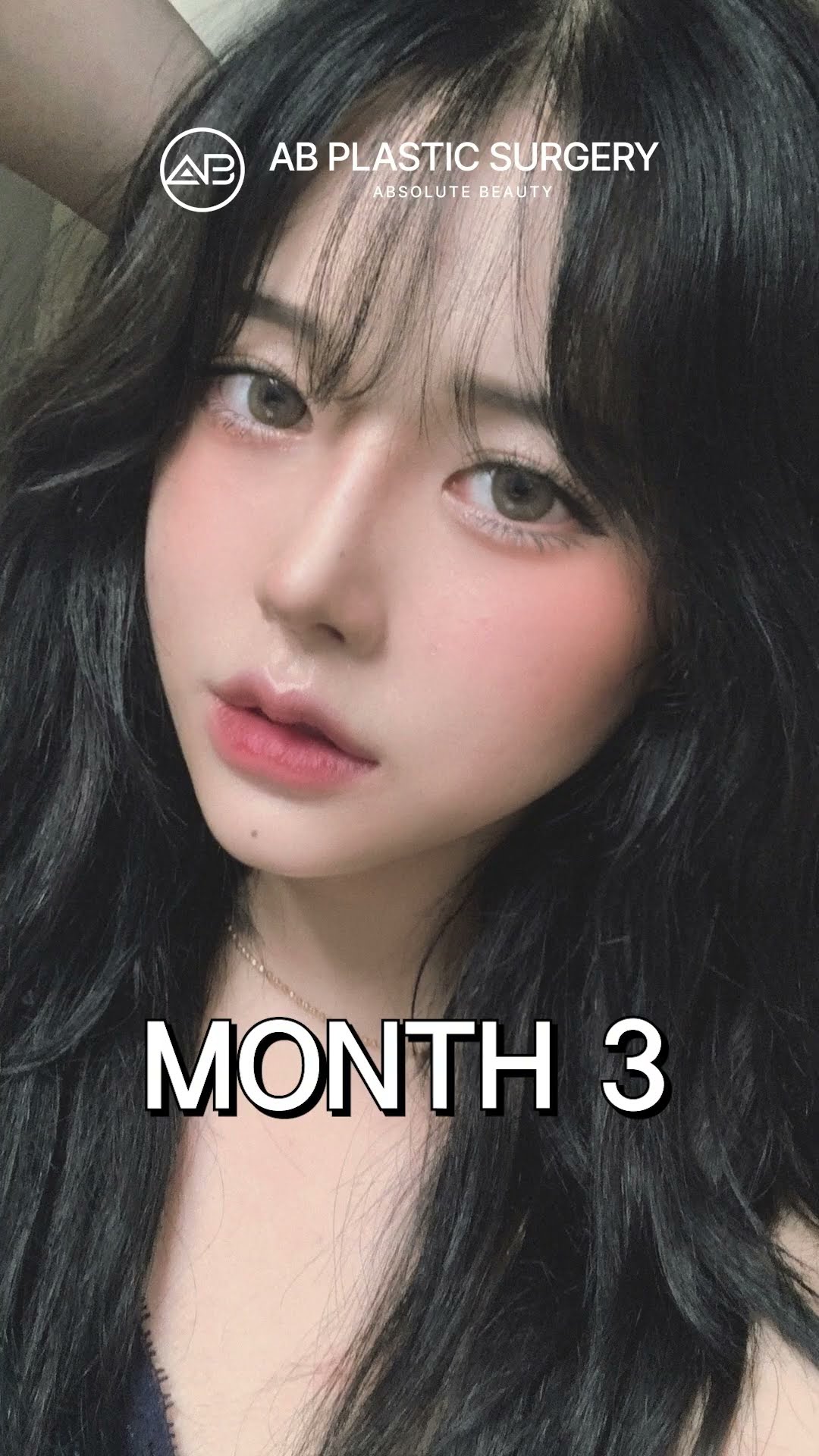 Why I got plastic surgery in Korea