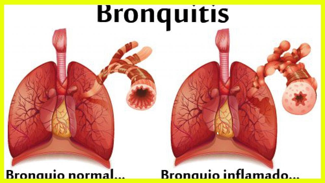 Plantas medicinales para tratar la bronquitis