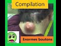 Compilation : Gros bouton / Big pimple 2020