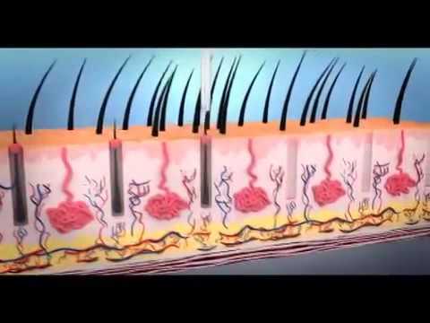 Saç Ekim İşlemi-عملية زرع الشعر