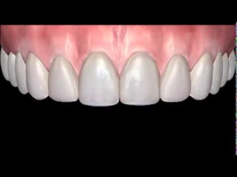 Smile Design