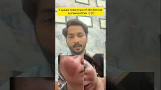 A Female Patient Case Of Skin Damage After Chemical Peel