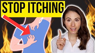 HOW TO STOP ITCHING ON THE BACK | Notalgia Paresthetica