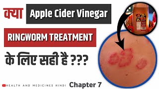 Treating Ringworm With Apple Cider Vinegar | रिंगवर्म का घरेलू इलाज | Ringworm Home Treatment