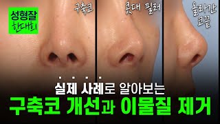 에디션의 코 성형 디테일을 총동원하게 만든 흔치 않은 사례 | 구축코 개선·이물질 제거