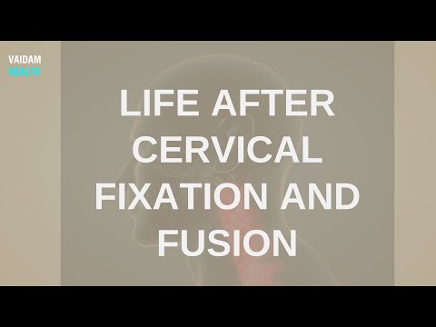 Life After Cervical Fixation and Fusion
