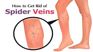 How to Get Rid of Spider Veins Naturally || Spider Veins Treatment || Home Remedies for Spider Veins