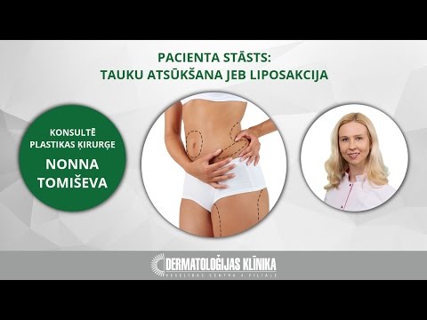 Pacienta stāsts: tauku atsūkšana jeb liposakcija
