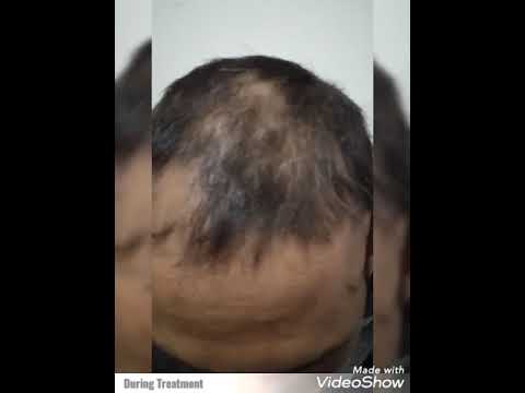 Hair fall treatment one month