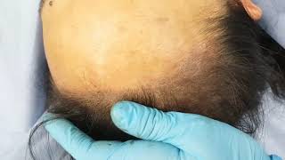 2nd Hairline Micopigmentation SMP Female by El Truchan @ Scalp Micro Definition