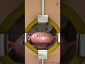 Myomectomy (Fibroid Removal) ↪ 3D Medical Animation #Myomectomy #Fibroid #Shorts #Abdominal
