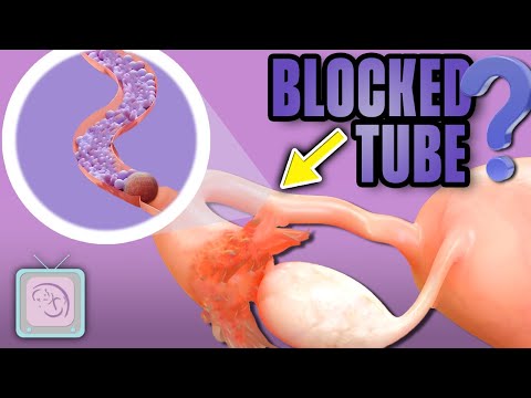 Blocked Tubes How to Avoid IVF and Surgery Fertility Expert Dr Randy Morris