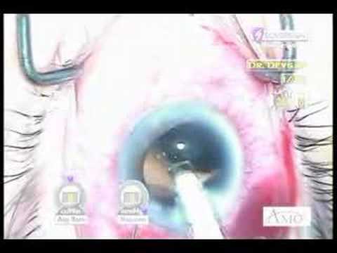 Glaucoma And Cataract Surgery