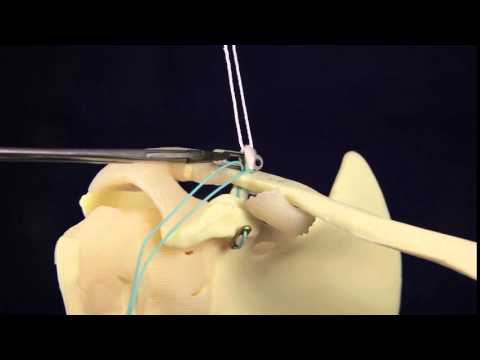 AC Joint Surgery Original technique