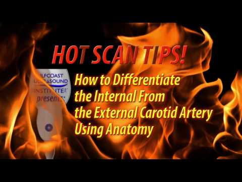 Hot Tip-How to Differentiate the Internal from the  External Carotid Artery